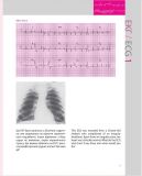 150 випадків ЕКГ=150 ECG Cases: пер. 5-го англ. вид.: Навч. посіб.. Изображение №18