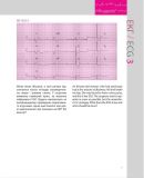 150 випадків ЕКГ=150 ECG Cases: пер. 5-го англ. вид.: Навч. посіб.. Изображение №22